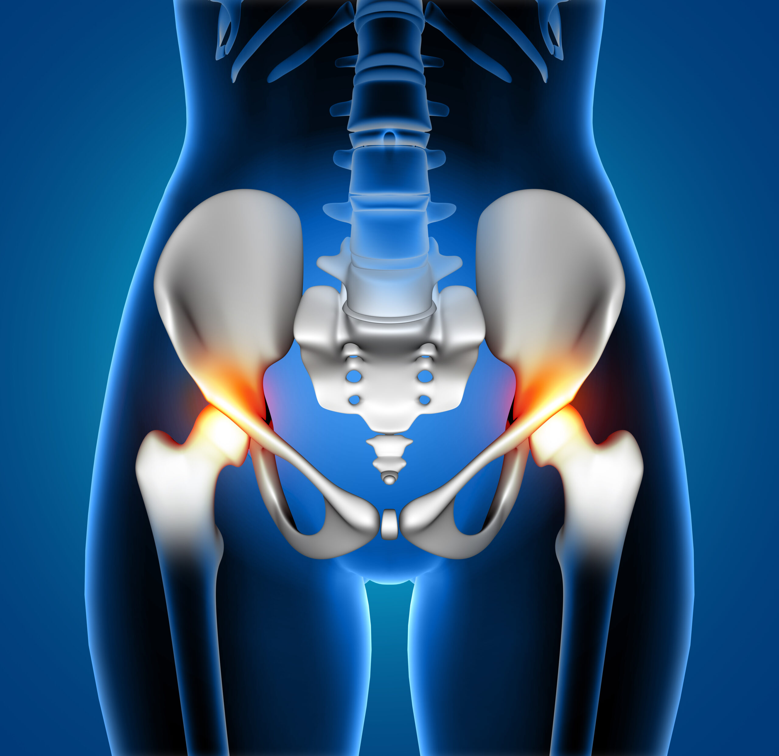 Hip Replacement Surgery Success Rate in India