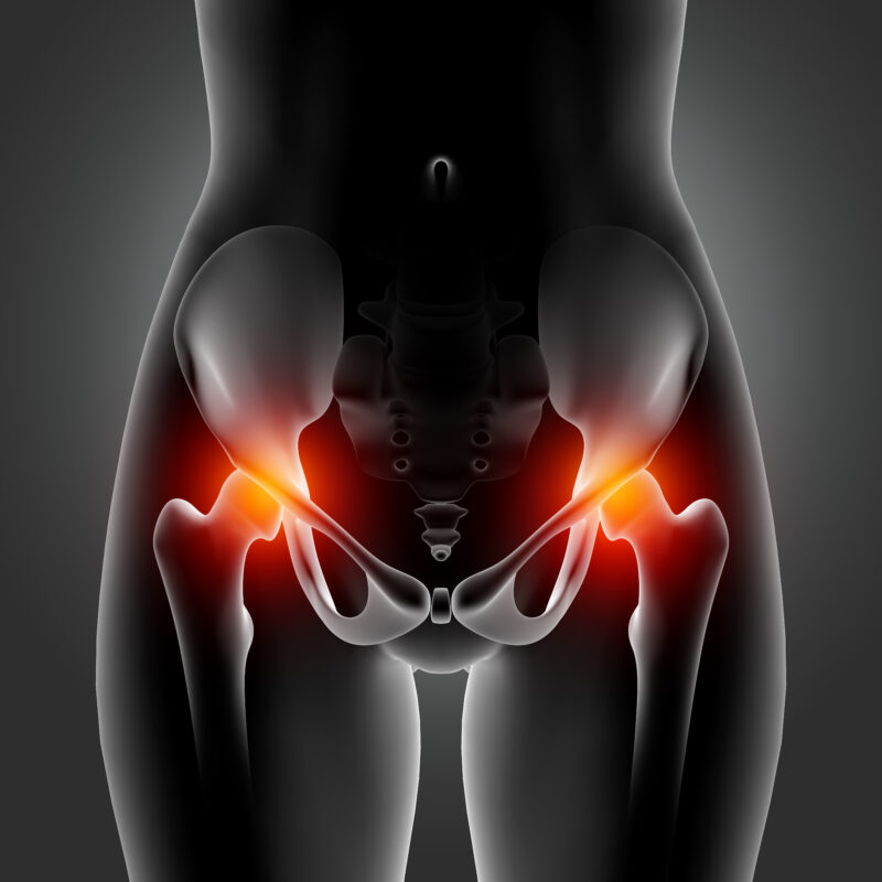 Cost of Hip Replacement Surgery in India: A Comprehensive Guide for Medical Tourists