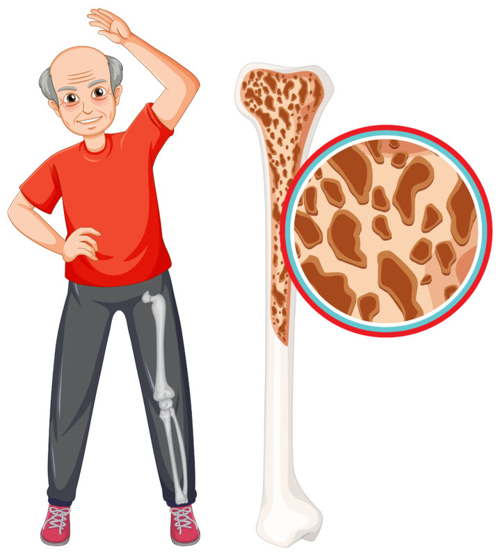 Bone Marrow Transplant