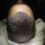 Best Hair Transplant Clinics in India