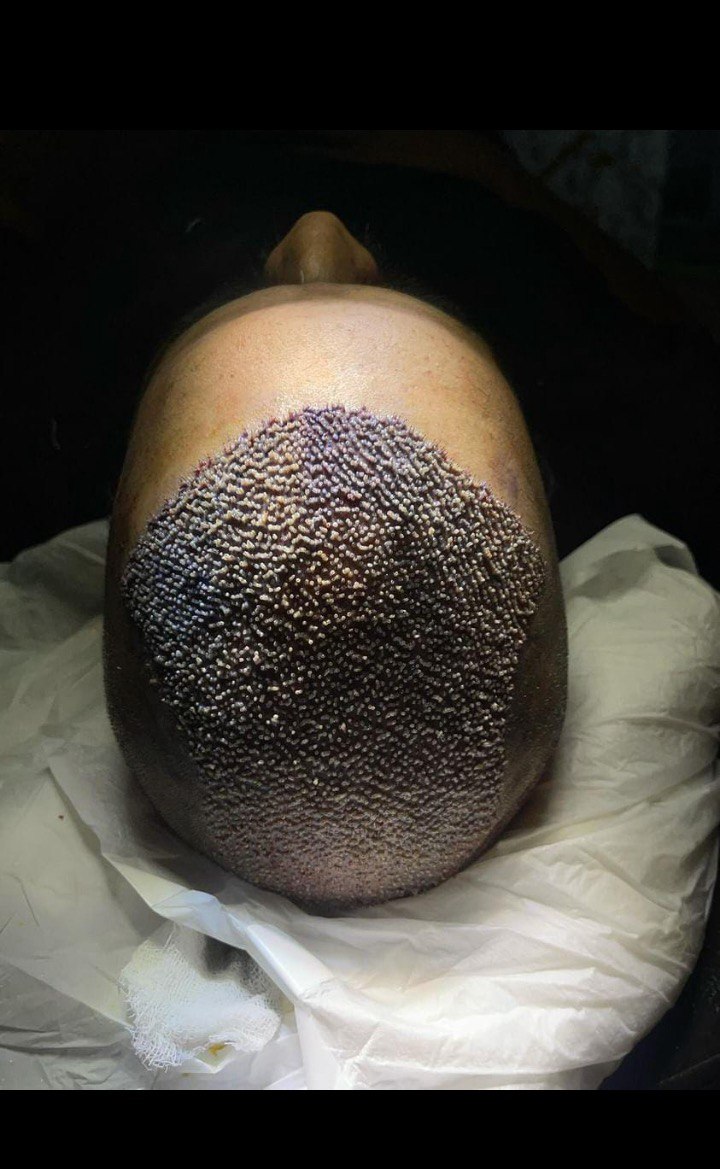 Best Hair Transplant Clinics in India