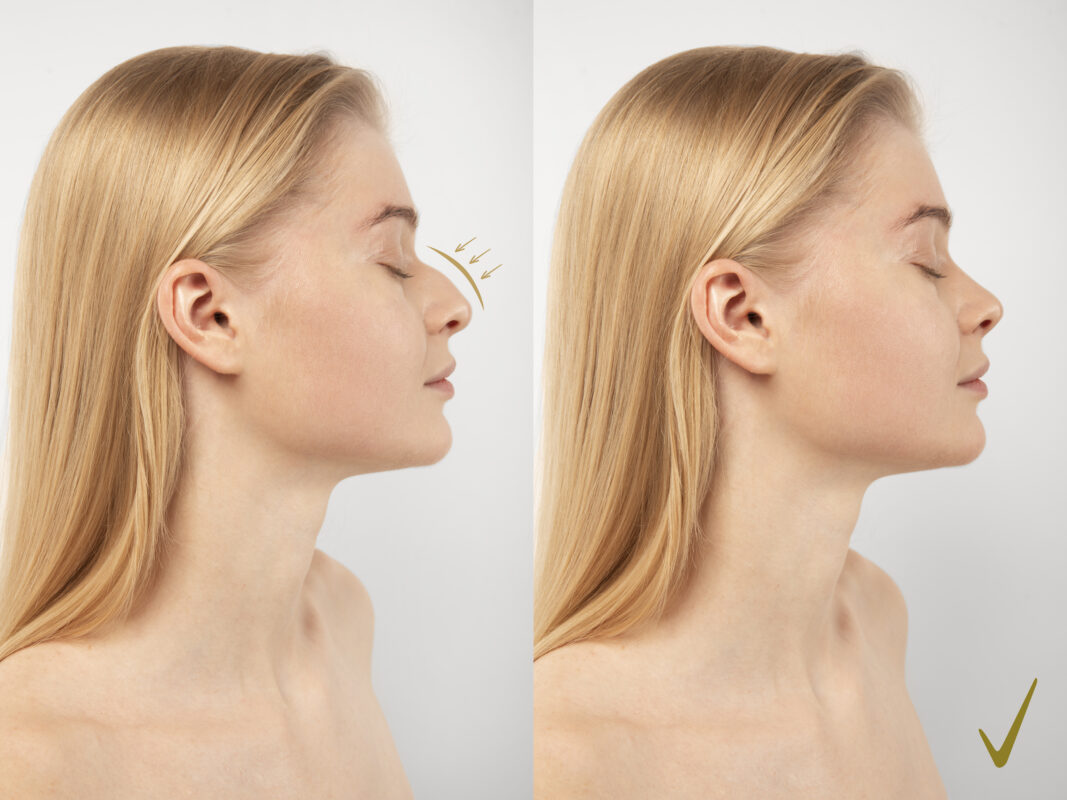 How Much Does Rhinoplasty Cost in India in 2025?