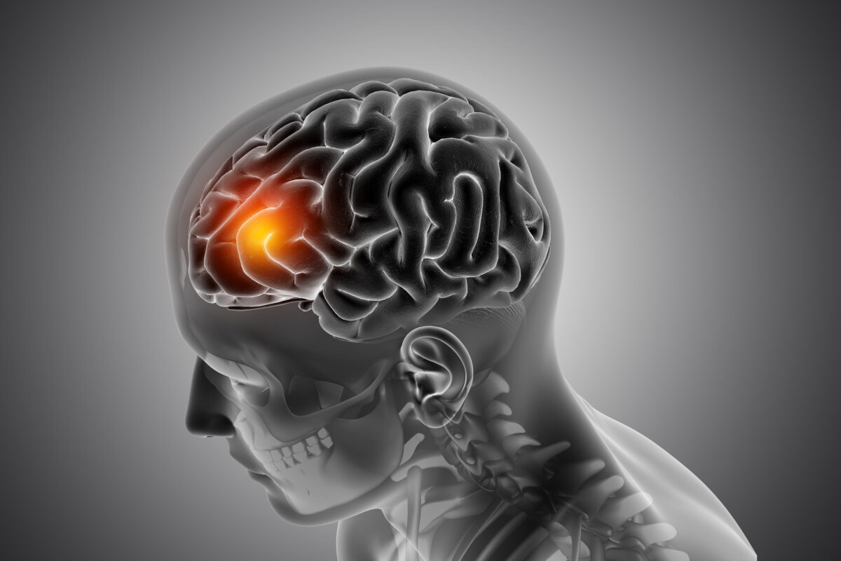 Medical illustration showing highlighted frontal brain region to represent brain tumor diagnosis and surgery