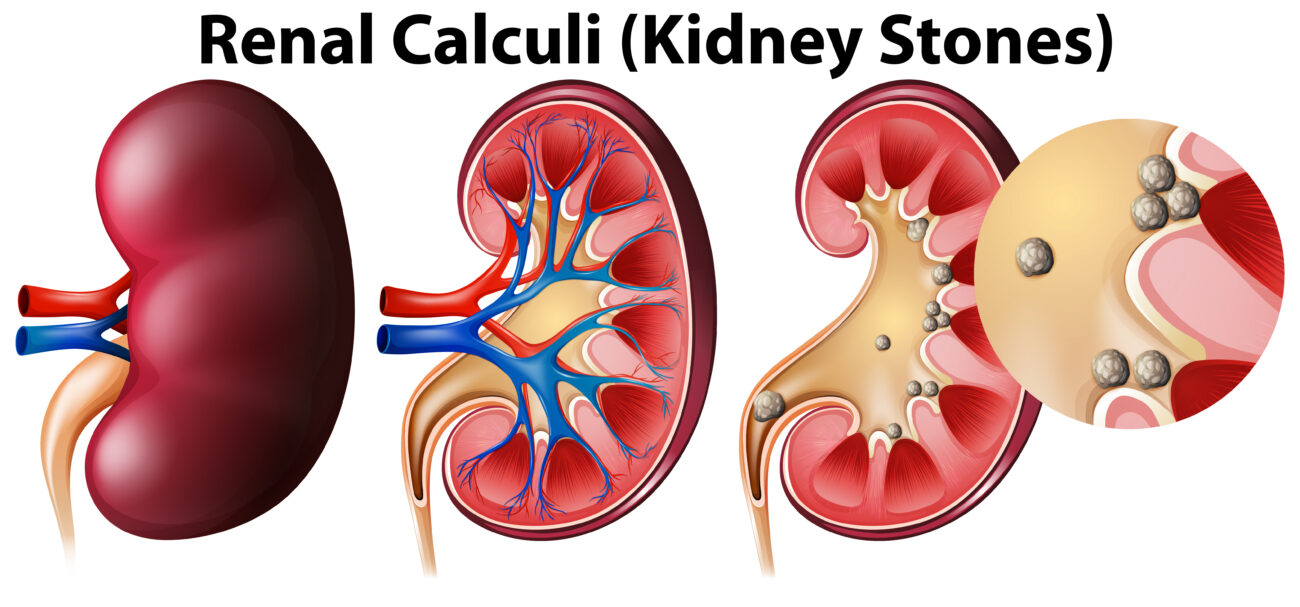 Illustration showing the development and location of renal calculi (kidney stones) inside the human kidney, highlighting stone formation and blockage in the urinary tract.