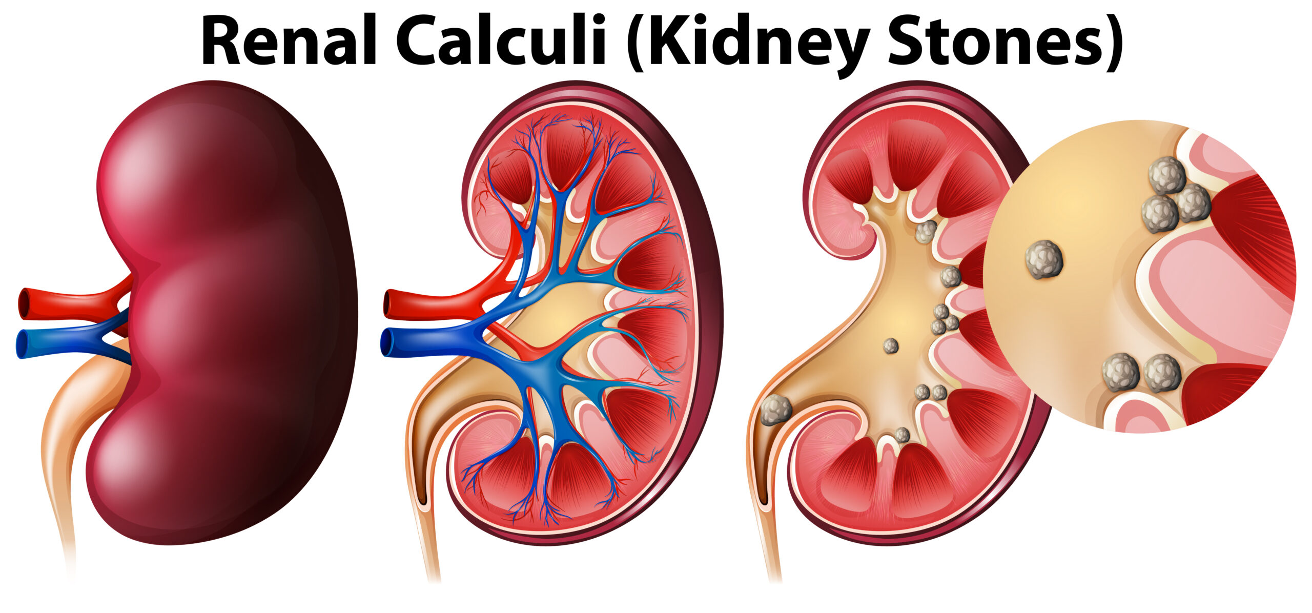 Illustration showing the development and location of renal calculi (kidney stones) inside the human kidney, highlighting stone formation and blockage in the urinary tract.