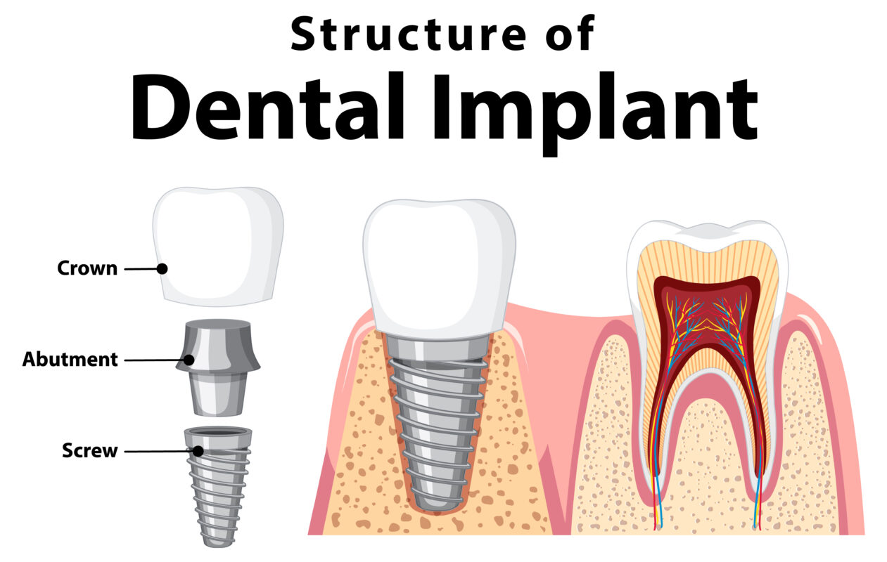 A labeled diagram shows the structure of a dental implant, with three parts: crown, abutment, and screw. The image compares an implanted tooth (in bone and gum) and a natural tooth, highlighting anatomy and integration.