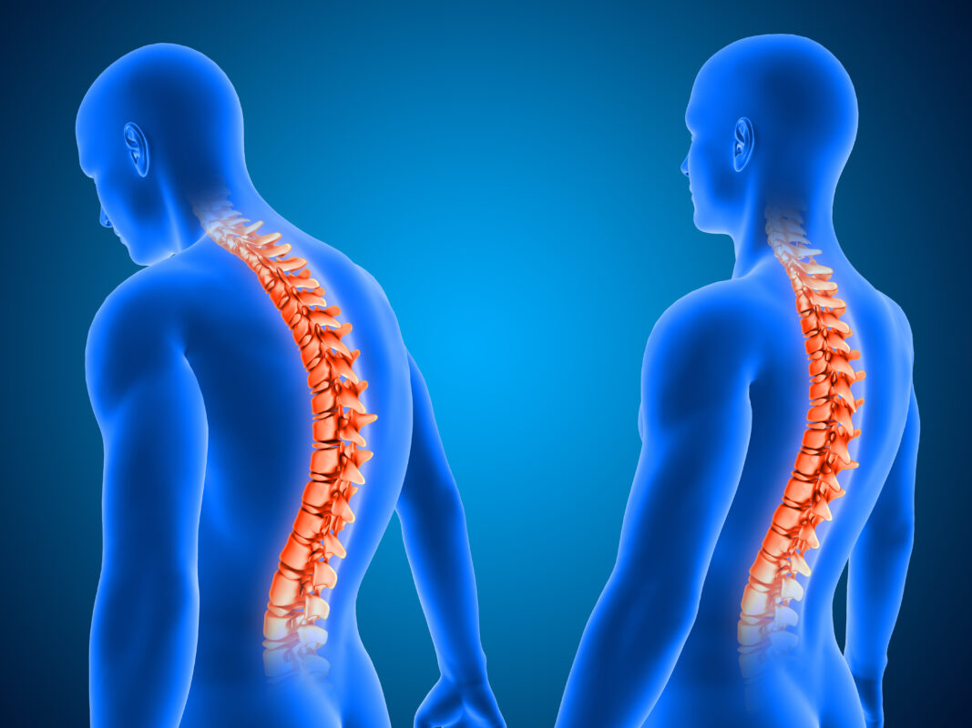 A medical illustration shows the human spine highlighted in orange within two blue-tinted, 3D-rendered male figures. One figure is viewed from the back with a curved spine, and the other from the side, displaying spinal anatomy in detail.