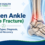Broken ankle (ankle fracture) infographic showing symptoms, types, diagnosis, treatment, and recovery with a highlighted ankle fracture.